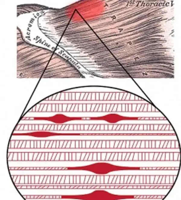 Illustration f myofascial trigger point in the upper trapezius